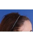 After Hair Transplant&nbsp;Hairline
